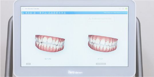 金属を使わないマウスピース矯正は違和感が少ない