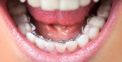 裏側矯正の特徴