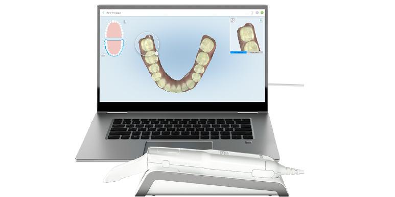 iTeroを用いたフルデジタルのマウスピース矯正治療