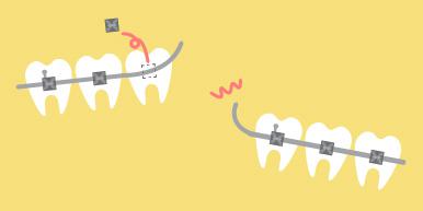 マウスピース矯正ならワイヤーなどによるトラブルが少ない