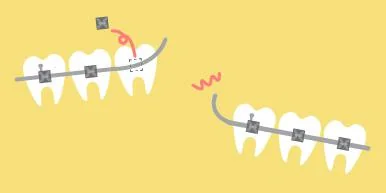マウスピース矯正ならワイヤーなどによるトラブルが少ない